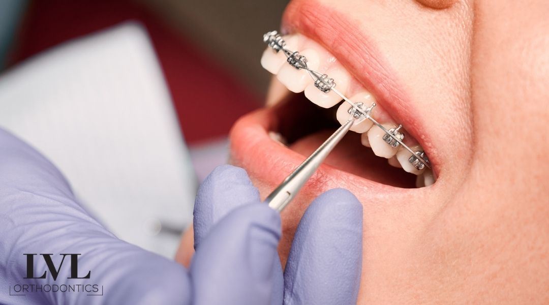 What To Do If Your Bracket Breaks LVL Orthodontics